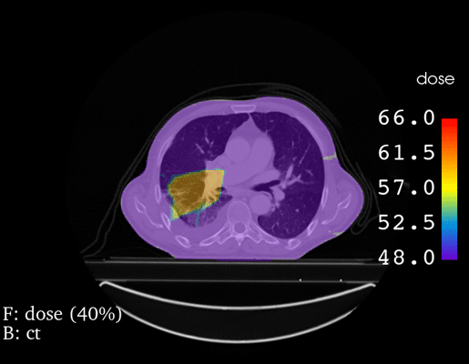 Dose Distribution 2